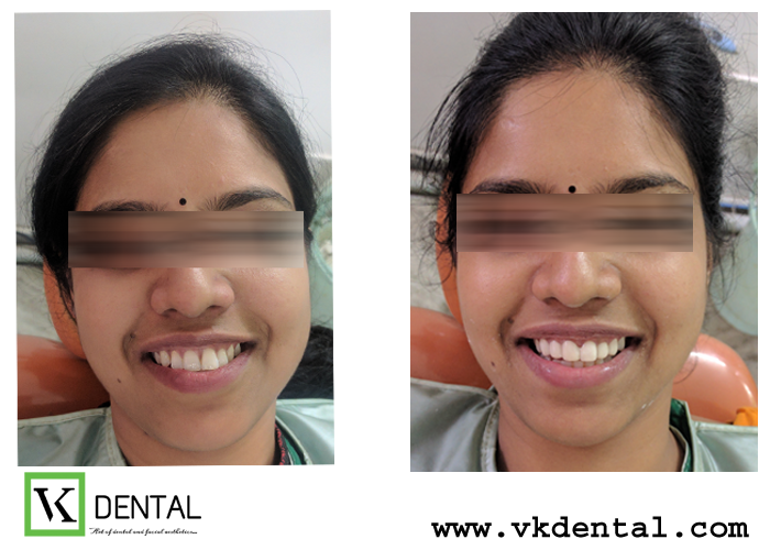 SMILE CORRECTION/DESIGNING